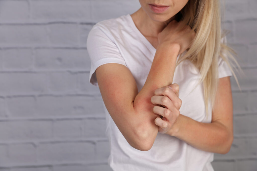 Woman scratching an irritated patch of skin on her elbow