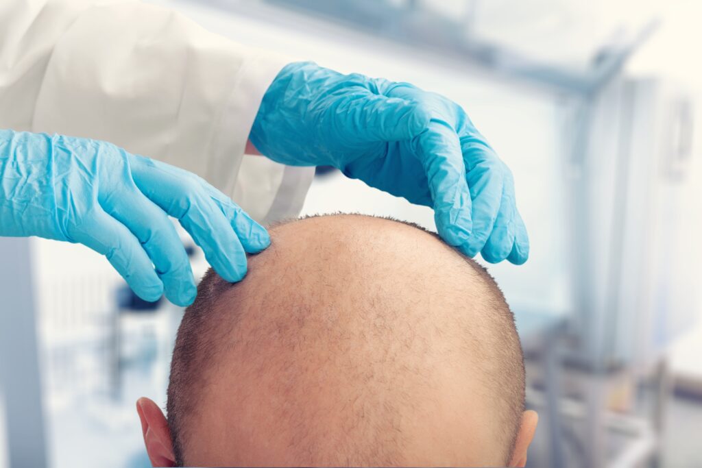 What is the Best Laser Cap For Hair Growth?