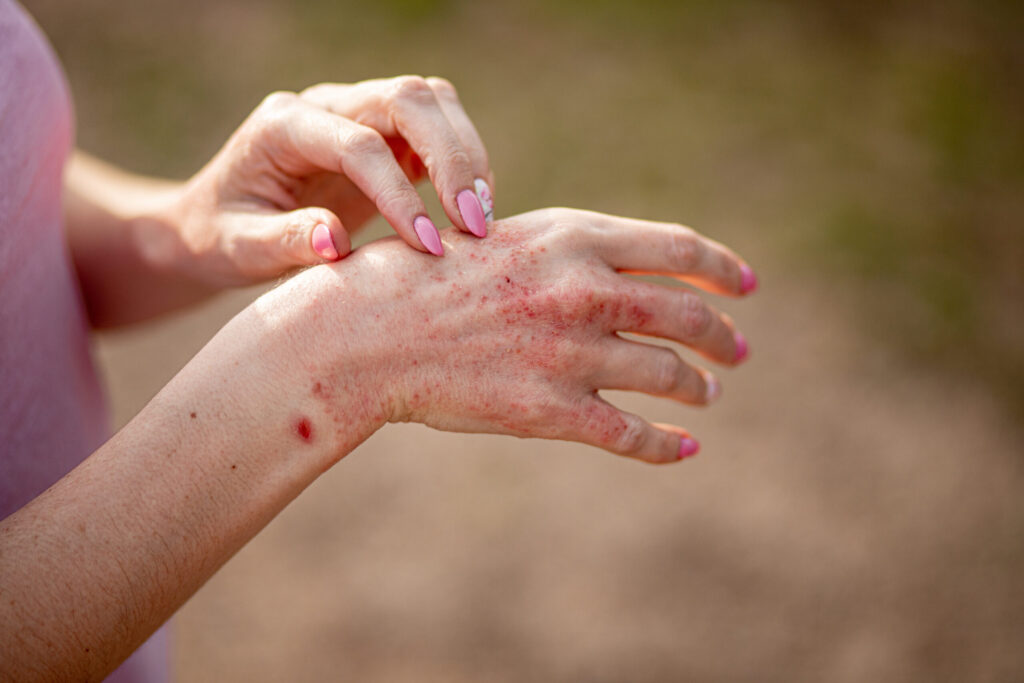Close up of dermatitis on a woman's hand