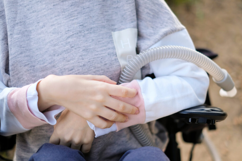 Adult Onset Spinal Muscular Atrophy: Diagnosis, Symptoms and Treatment
