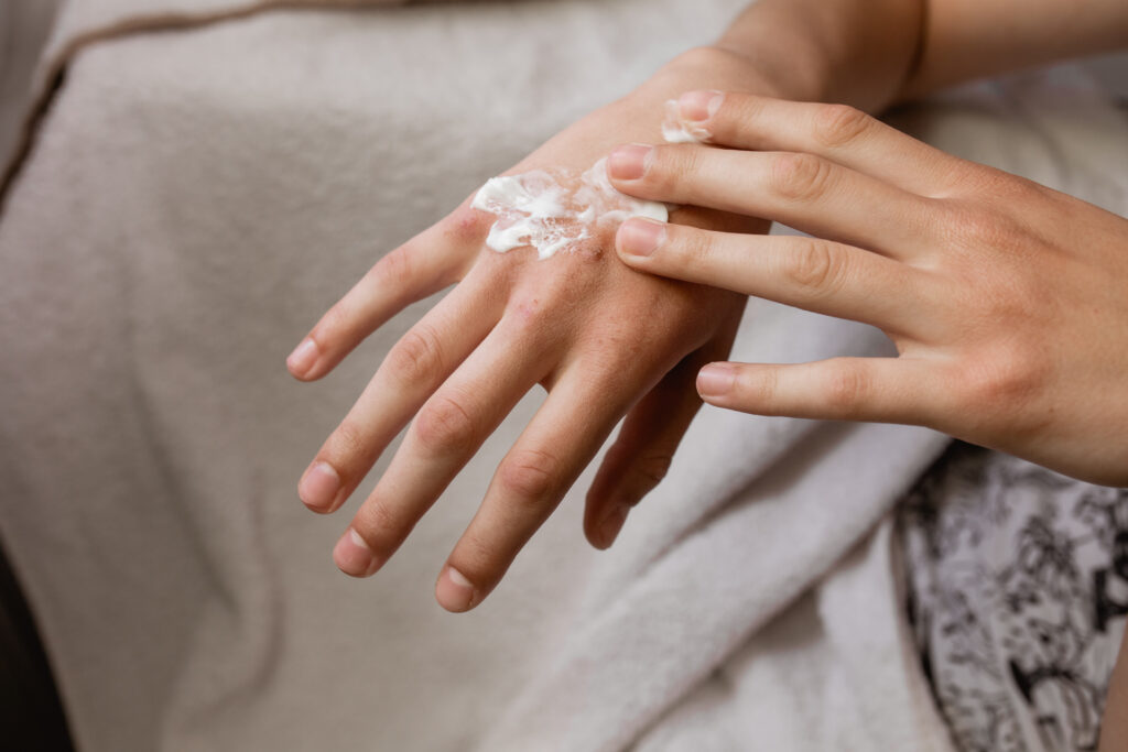 Dry hands with wounds and a person applying hand cream to eczema.