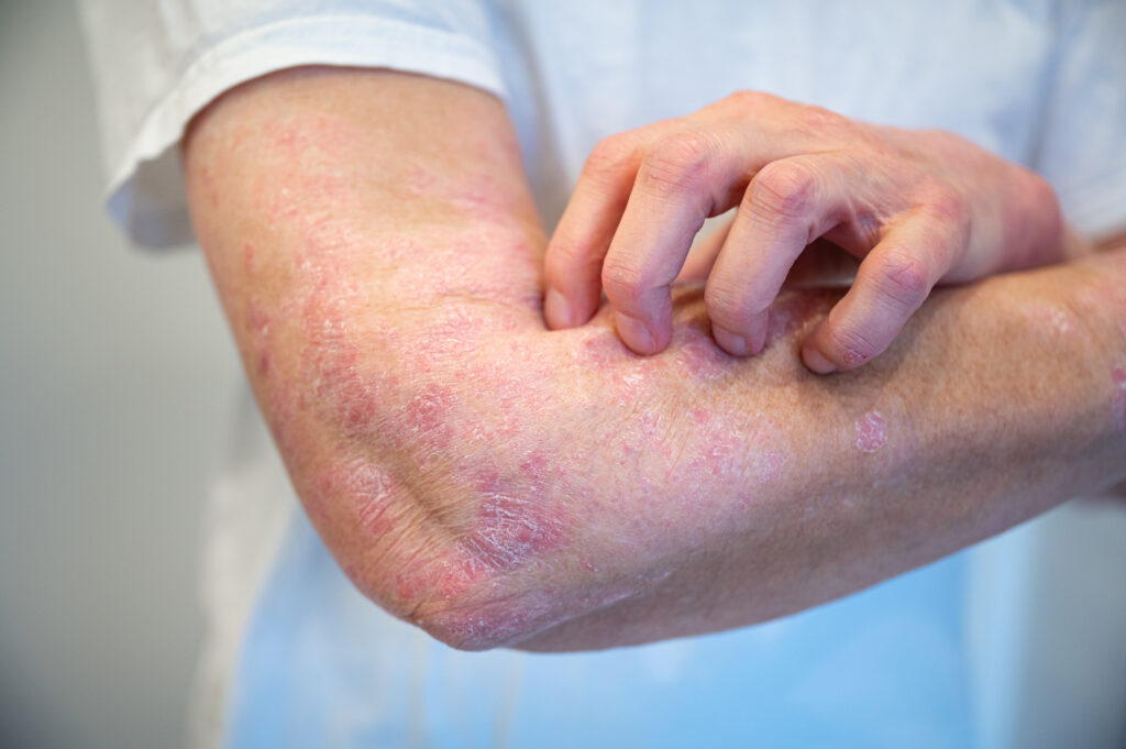 Acute psoriasis on the elbows of a man