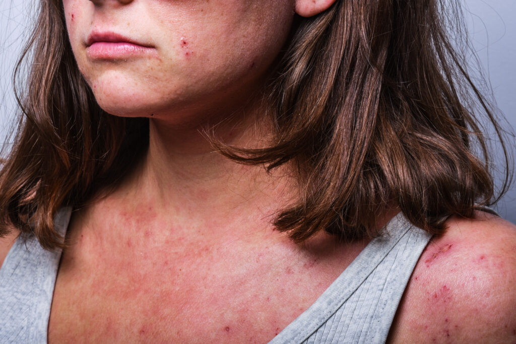 Young woman with dermatitis on her face and neck.