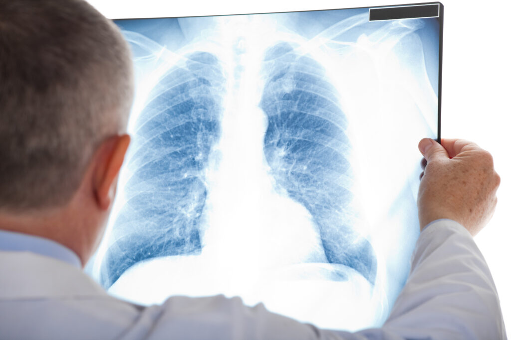 Lung Cancer: Types and Early Signs of This Condition