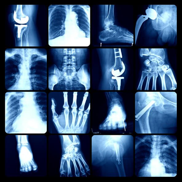 Bone density x ray images