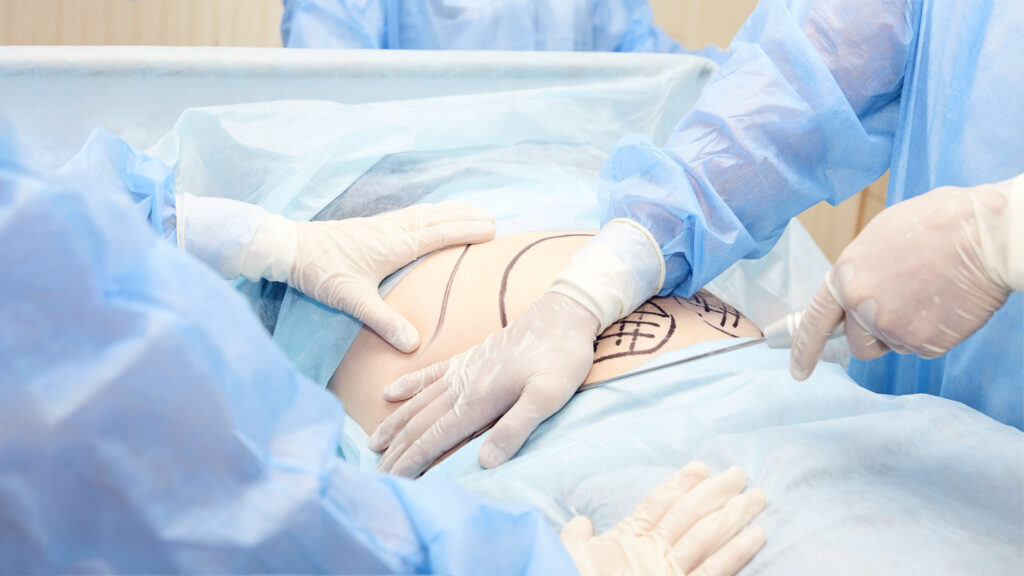 How Do Liposuction Treatments Work?