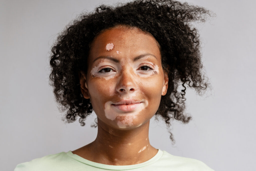 What You Need to Know About Vitiligo
