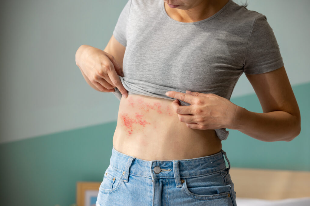 Shingles (Herpes Zoster): Symptoms & Treatment