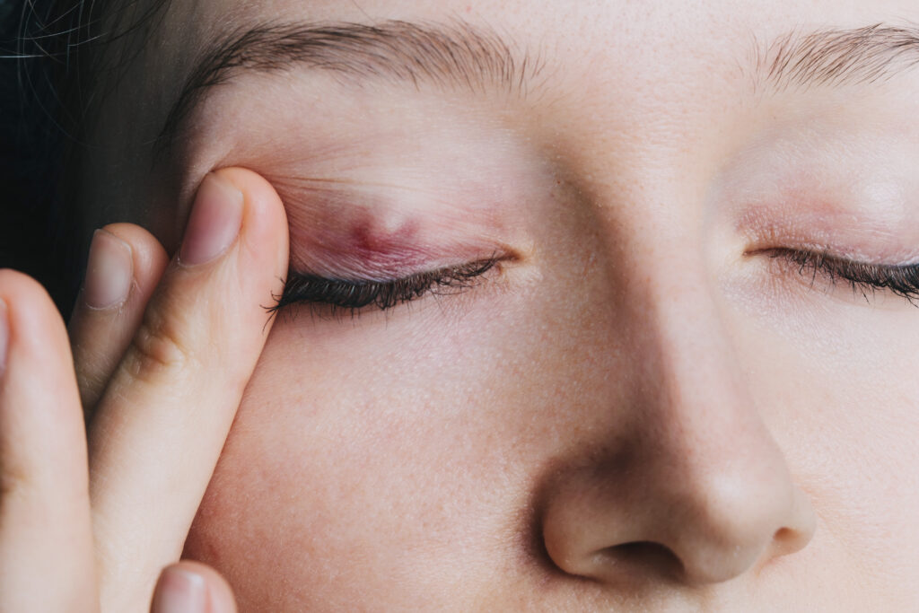 Stye (Sty): What Is It, Causes, Treatment & Prevention