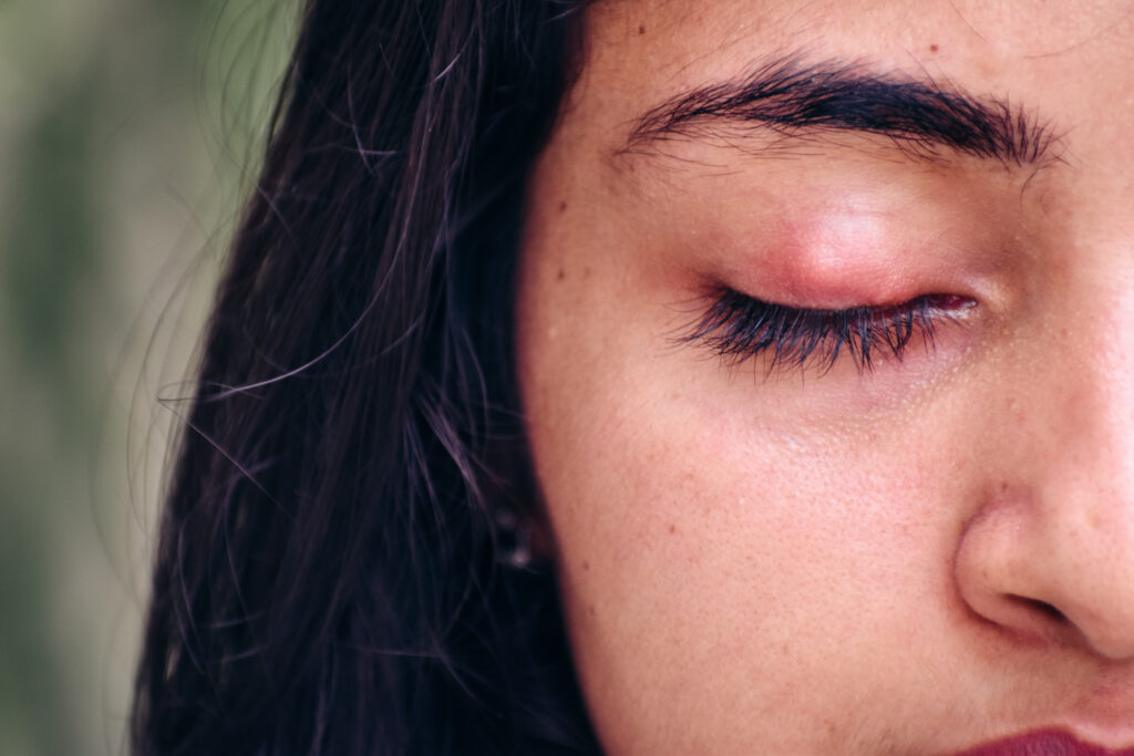 Woman with staph infection on her upper eyelid