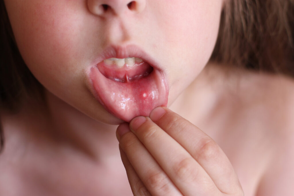 Canker Sore (Aphthous Ulcer): What It Is, Causes & Treatment