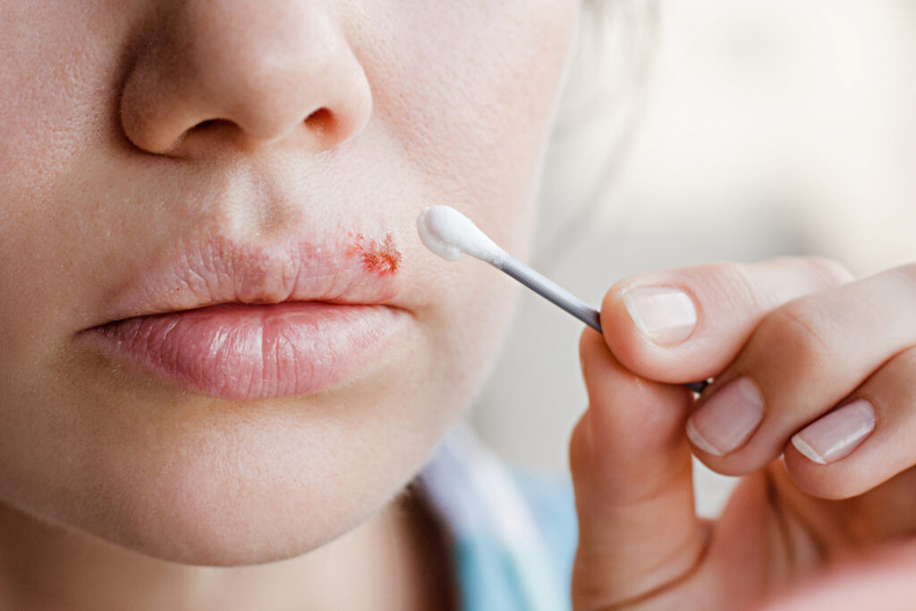 Cold Sores: Causes, Treatment and Prevention