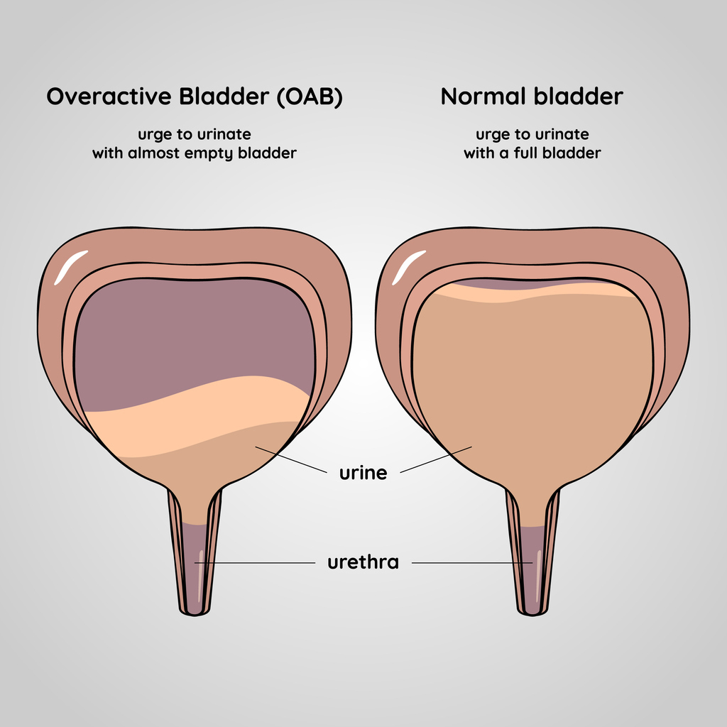 Overactive bladder: What you need to know