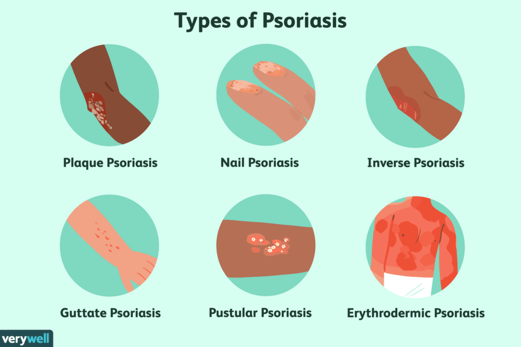 Ointments for psoriasis